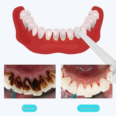 Ultrasonic Dental Scaler & Calculus Remover - 3 Modes, 2 Heads, LED Light(white)